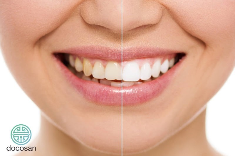 Chia sẻ cách tẩy trắng răng bị ố vàng tại nhà